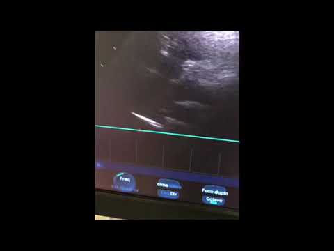 Transthoracic echocardiography scan in Covid-19 patient under mechanical ventilation in prone position