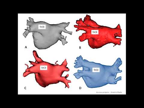 Anatomia das VP e ablação de FA