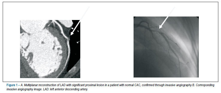Calcium score to evaluate chest pain in the emergency room