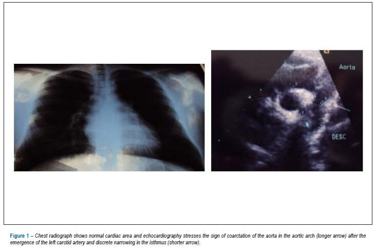 Case 1/2013: 20-year-old man with native and evolutionary coarctation in aortic arch