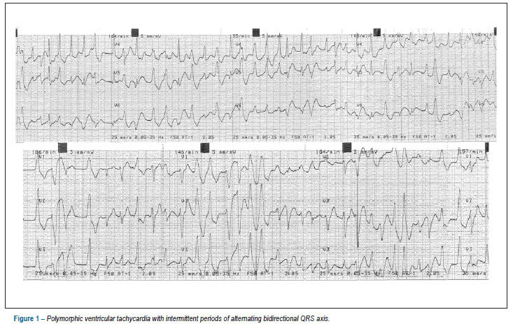 Recurrent infection in a late presentation of catecholaminergic polymorphic VT