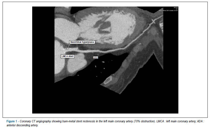 Takayasu arteritis: stenosis after bare-metal and drug-eluting stent implantation
