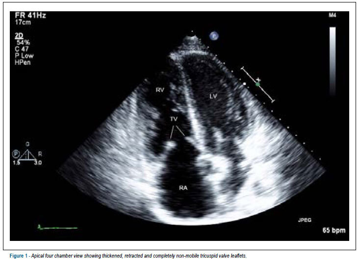 Carcinoid heart disease