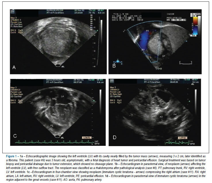 Heart neoplasms in children: retrospective analysis