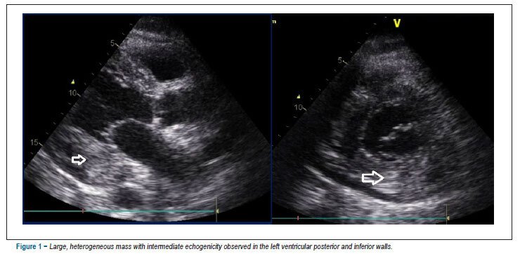 Non-Hodgkin lymphoma as an uncommon cause of acute heart failure