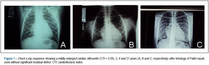 Case 2/2013: 23-year-old woman with dilated right ventricle, with no residual defects after repair of tetralogy of fallot