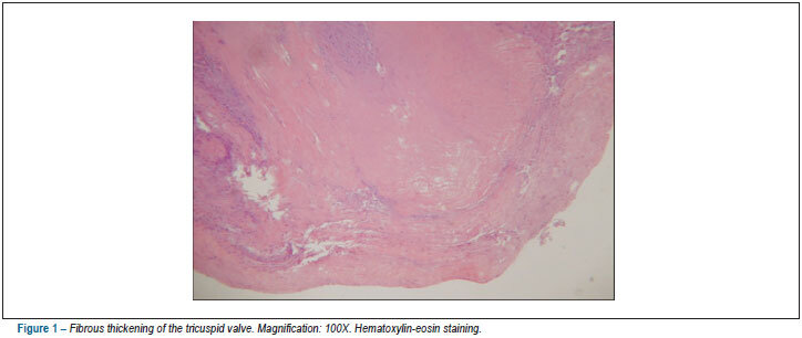 Double valve replacement due to dysfunction secondary to carcinoid tumor