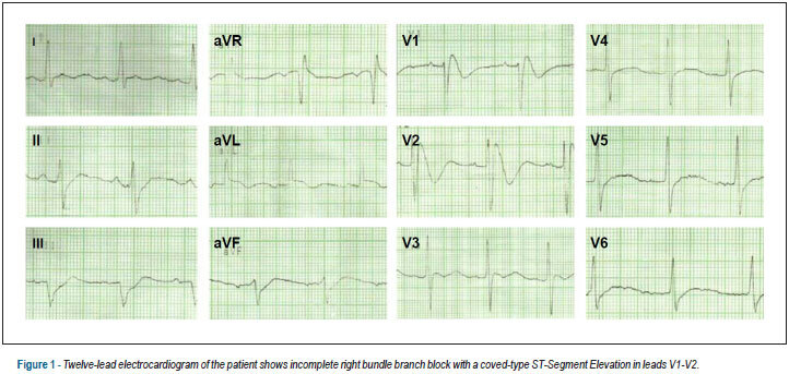 Brugada-like electrocardiographic changes induced by hypokalemia