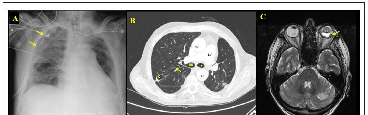 Immunocompromised patient with multiple cardiac masses