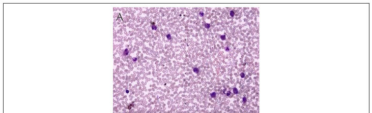 Idiopathic hypereosinophilic syndrome presenting as severe loeffler's endocarditis