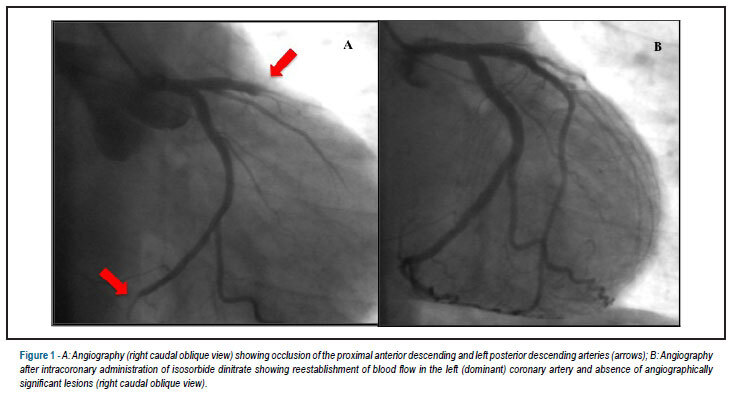 Apical ballooning syndrome during diagnostic coronary angiography