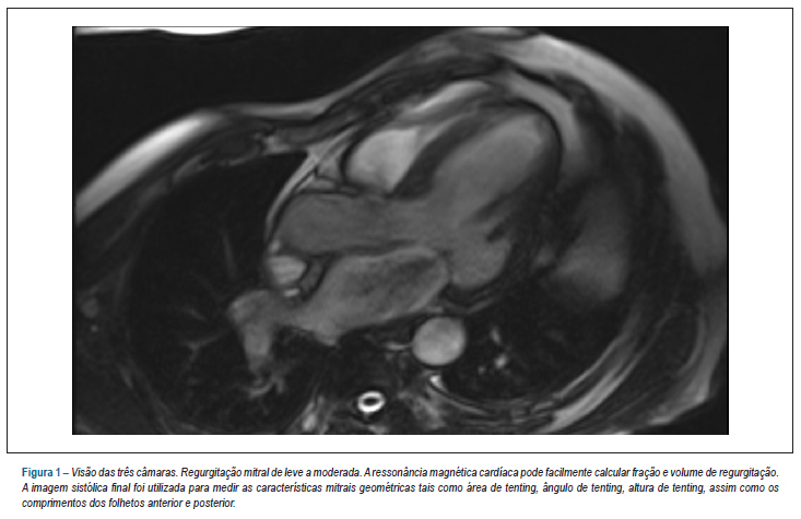 Geometria da valva mitral derivada da ressonância magnética cardiovascular na avaliação da gravidade da regurgitação mitral