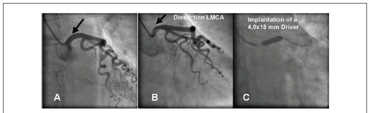 Stent dislodgement in the treatment of left main coronary artery dissection