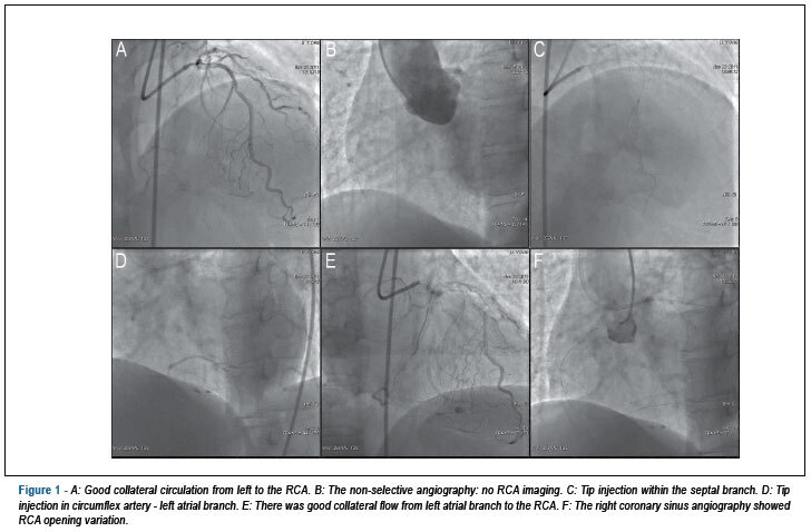 Retrograde guidewire trapping technique for total right coronary occlusion with unusual ostial origin