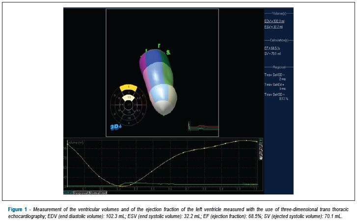 3D Echo pilot study of geometric Left Ventricular changes after acute myocardial infarction