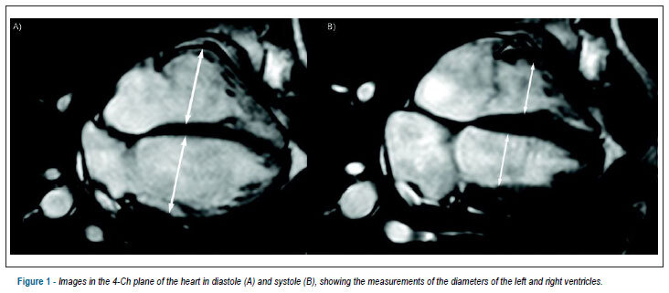 Morphological and functional measurements of the heart obtained by magnetic resonance imaging in Brazilians