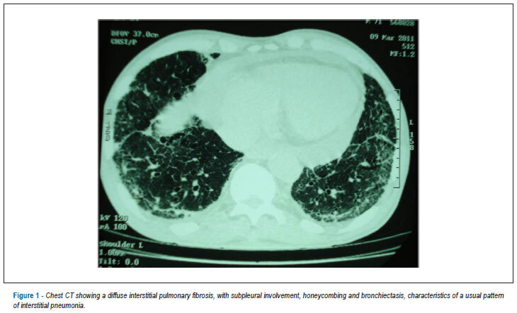 Case 3: - congestive heart failure in male with systemic sclerosis