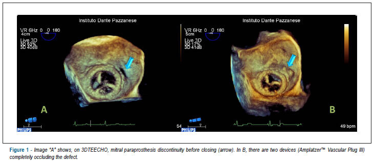 3D transesophageal echo in percutaneous correction of paraprosthetic regurgitation
