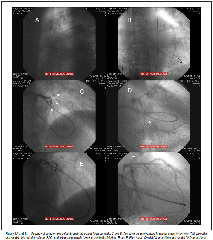 Transseptal coronary angioplasty in patients with severe peripheral vascular disease
