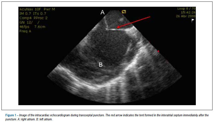 Are the virtual lines created with the ensite electroanatomical mapping system really continuous?