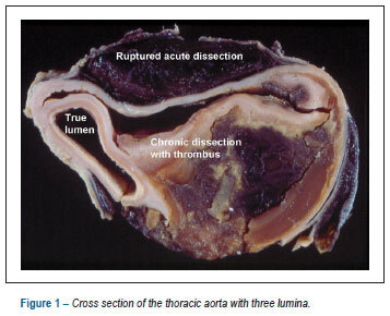Aortas with three lumina