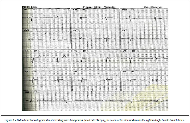 Dextrocardia with situs inversus associated with non-compaction cardiomyopathy