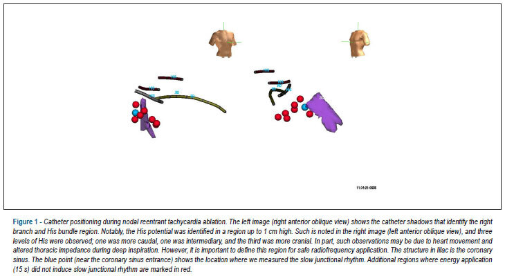 Catheter ablation of arrhythmias exclusively using electroanatomic mapping: a series of cases