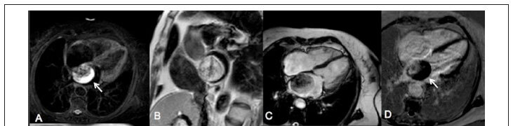 Magnetic resonance imaging evaluation of cardiac masses
