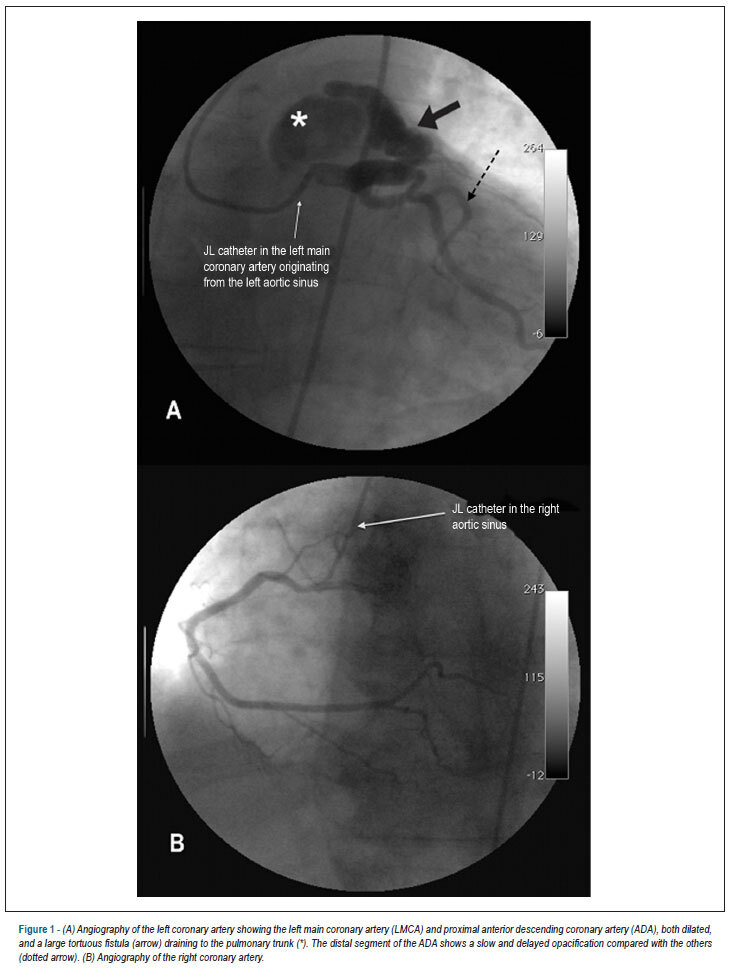 Percutaneous management of coronary artery fistula in an adult and clinical outcome