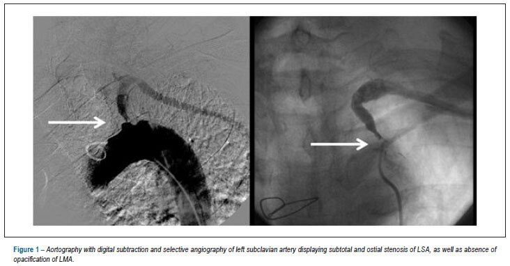 Percutaneous treatment of refractory angina secondary to left subclavian artery stenosis in patients after coronary artery bypass grafting