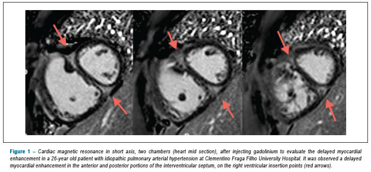 Pulmonary arterial hypertension: use of delayed contrast-enhanced cardiovascular magnetic resonance in risk assessment
