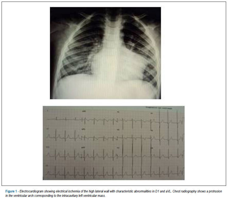 Case 5/2013 - a four-year-old boy with a rhabdomyoma-type cardiac tumor in both ventricles and repeated ventricular tachycardia