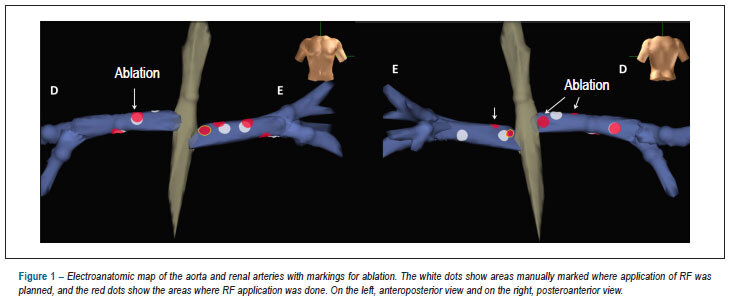 Renal denervation by ablation with innovative technique in resistant hypertension