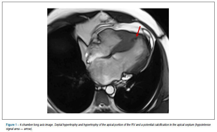 Exuberant pattern of late gadolinium enhancement in hypertrophic cardiomyopathy