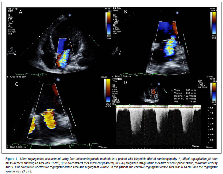 Criteria for mitral regurgitation classification were inadequate for dilated cardiomyopathy