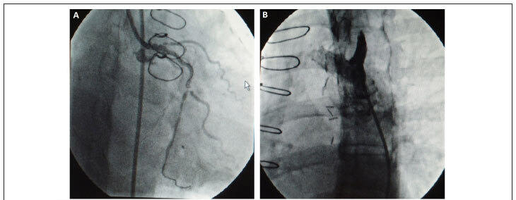 Steal of blood flow from the vertebral artery to the internal thoracic artery anastomosed to the coronary artery