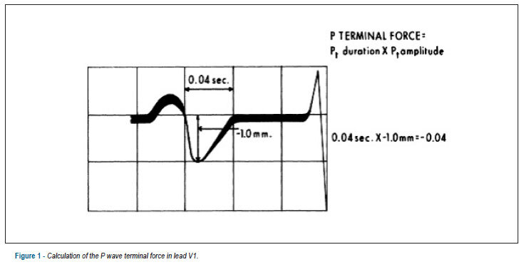 P wave indices to predict atrial fibrillation recurrences post pulmonary vein isolation