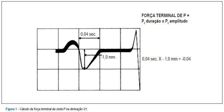 Índices de onda P na predição de recorrência de fibrilação atrial após isolamento da veia pulmonar
