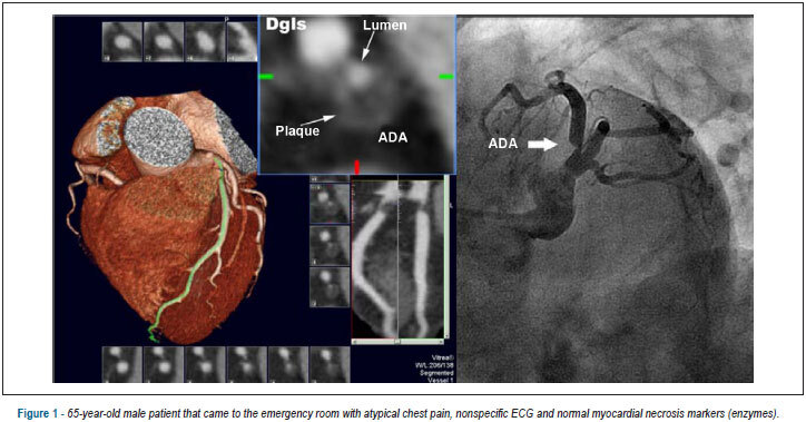 Coronary computed tomography angiography in the assessment of acute chest pain in the emergency room