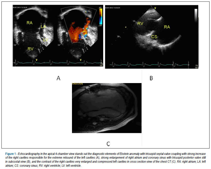 Case 6/2013: 56 years old woman with Ebstein anomaly in heart failure