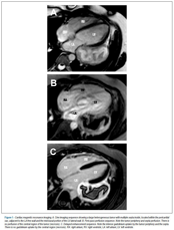 Pericardial synovial sarcoma: case report and literature review