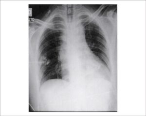 Arq Bras Cardiol. 2014; 102(2):e11-e16 Figure 2