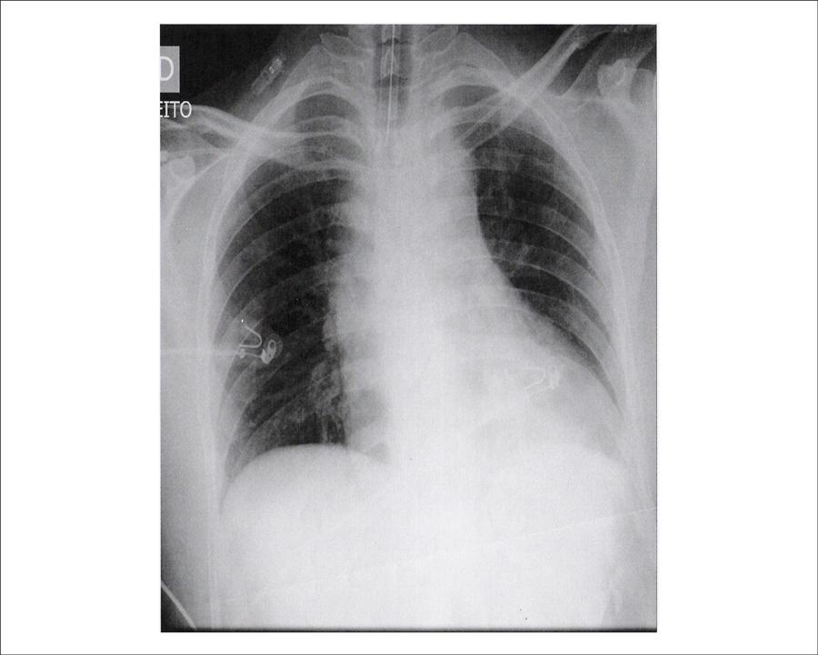 Arq Bras Cardiol. 2014; 102(2):e11-e16 Figure 2