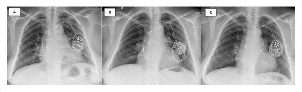 (A) Chest X-ray after pacemaker implantation (A). (B) Four days later, chest X-ray showed the displacement of the leads into the right atrium and the superior vena cava, with both the leads being wrapped around the pacemaker generator. (C) A few months later, a repeat chest X-ray showed a similar displacement of both the leads.