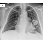 (A) Chest X-ray after pacemaker implantation (A). (B) Four days later, chest X-ray showed the displacement of the leads into the right atrium and the superior vena cava, with both the leads being wrapped around the pacemaker generator. (C) A few months later, a repeat chest X-ray showed a similar displacement of both the leads.