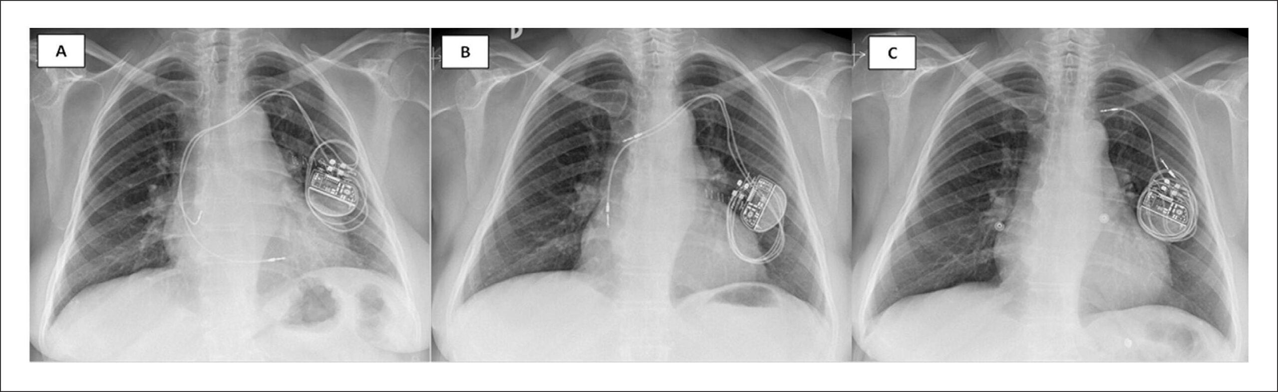 Reel Syndrome: an Unusual Complication of Cardiac Pacemaker Implantation
