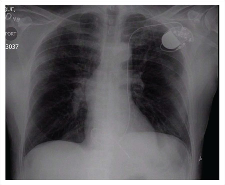 Persistent Left Superior Vena Cava in Permanent Pacemaker Implantation