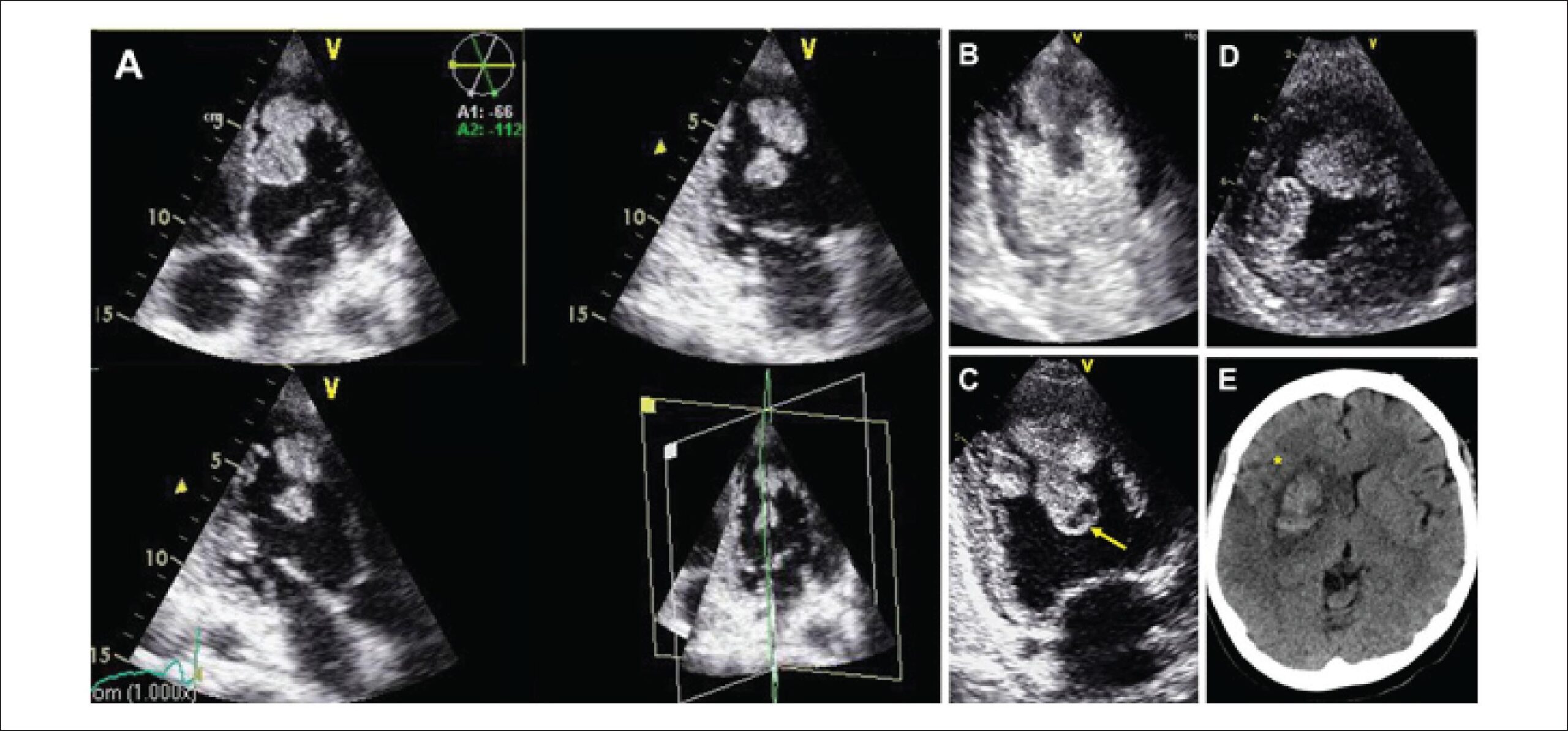 Trombose Intraventricular Maciça em uma Mulher Jovem com Cardiomiopatia Dilatada Idiopática