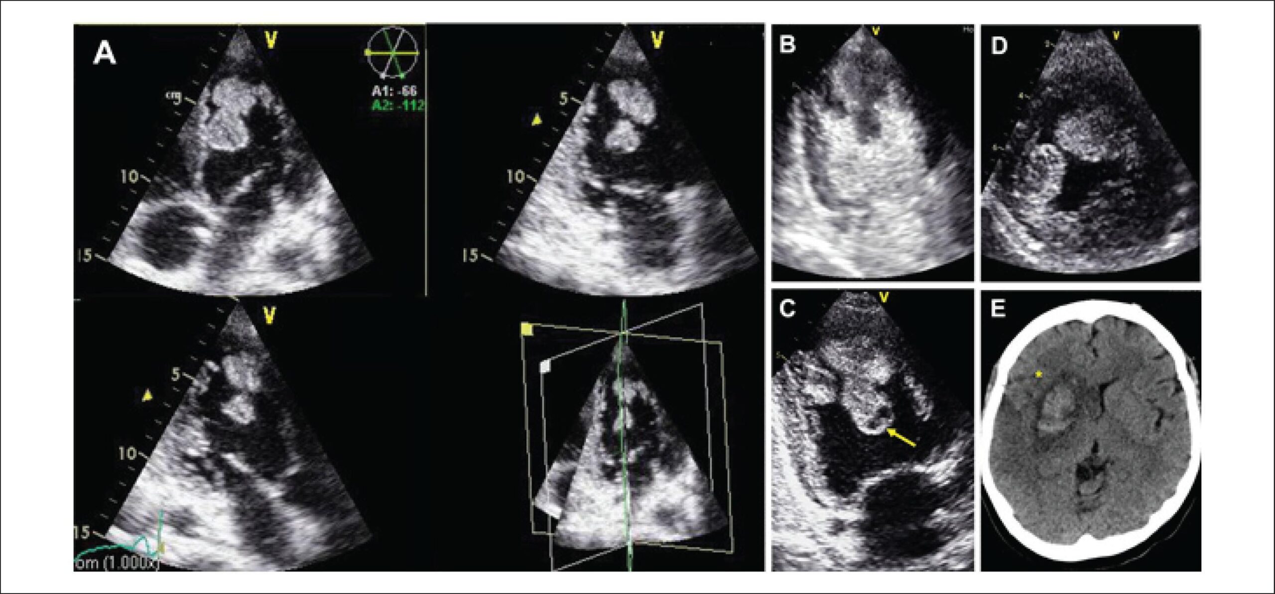 Massive Intraventricular Thrombosis in a Young Woman with Idiopathic Dilated Cardiomyopathy