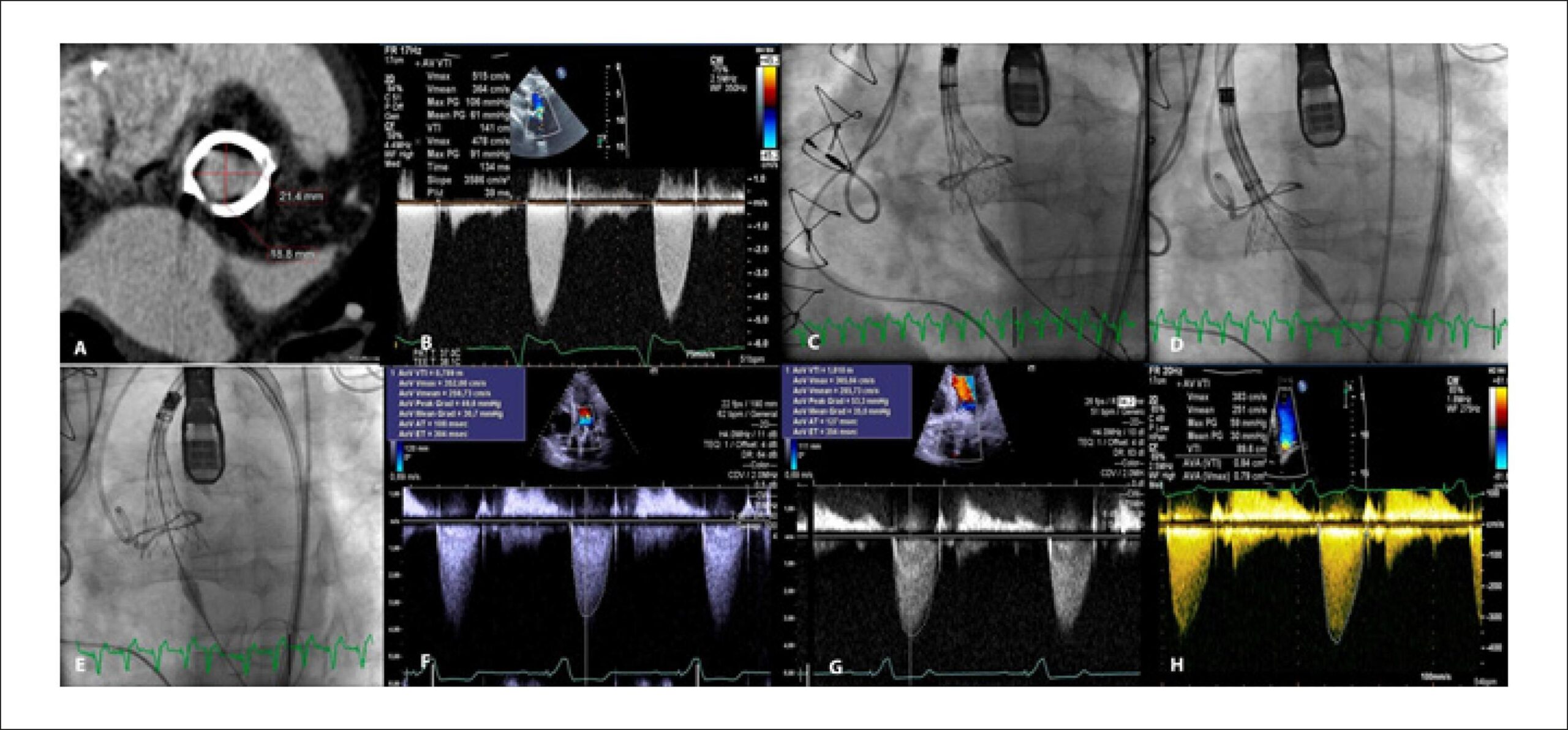 Reposicionamento Percutâneo de uma CoreValve®Evolut™ R numa Bioprótese Aórtica